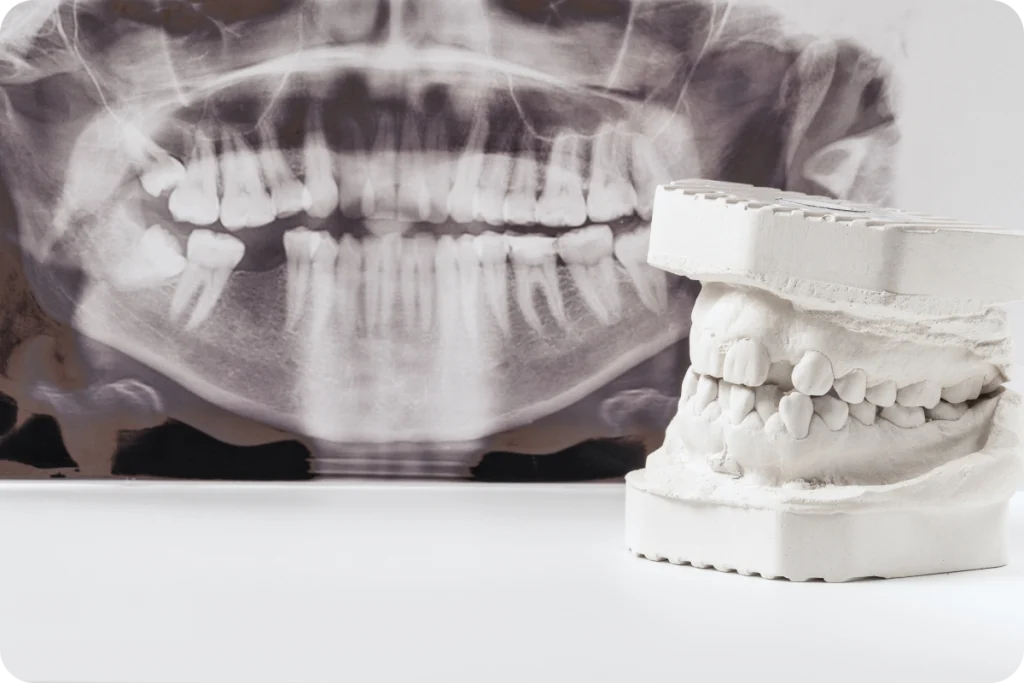 pose implant dentaire narbonne mastication pose implant dentaire narbonne mastication Dentiste à Narbonne, Cabinet dentaire La Tramontane