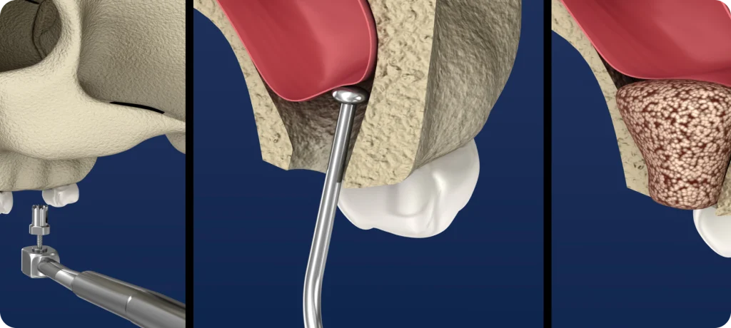 sinus lift narbonne greffe osseuse Dentiste à Narbonne, Cabinet dentaire La Tramontane