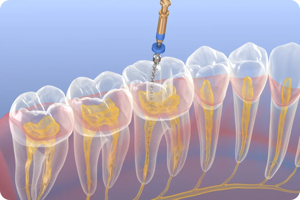 traitement endodontique narbonne dentiste traitement endodontique narbonne dentiste Dentiste à Narbonne, Cabinet dentaire La Tramontane